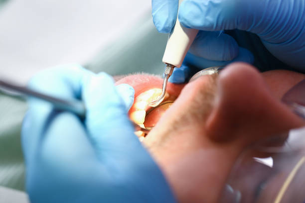 Best Broken or Chipped Tooth Repair in Rockville, IN