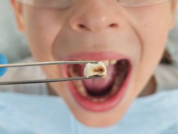 Best Knocked-Out Tooth (Avulsed Tooth) Treatment in Rockville, IN